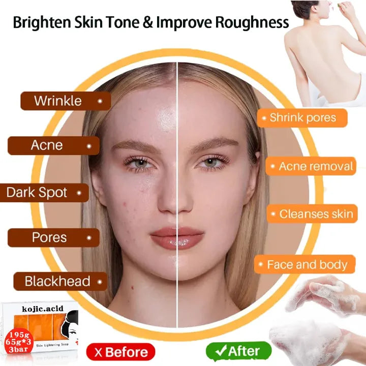 Kojic Acid Skin Brightening Soap 3Pcs * 65g, Facial Soap, Solid Soap Bar For Effectively Removing Acne Spots, And Used For Deeply Cleaning Face And Body Skin