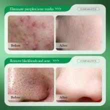 SADOER 3 in 1 Set, Acne Repair Serum + Cream + Cleanser with 3% Salicylic Acid Collagen Peptide and Niacinamide, Centella Asiatica and Niacinamide, Can add Vitamin C,Remove Acne, Moisturize